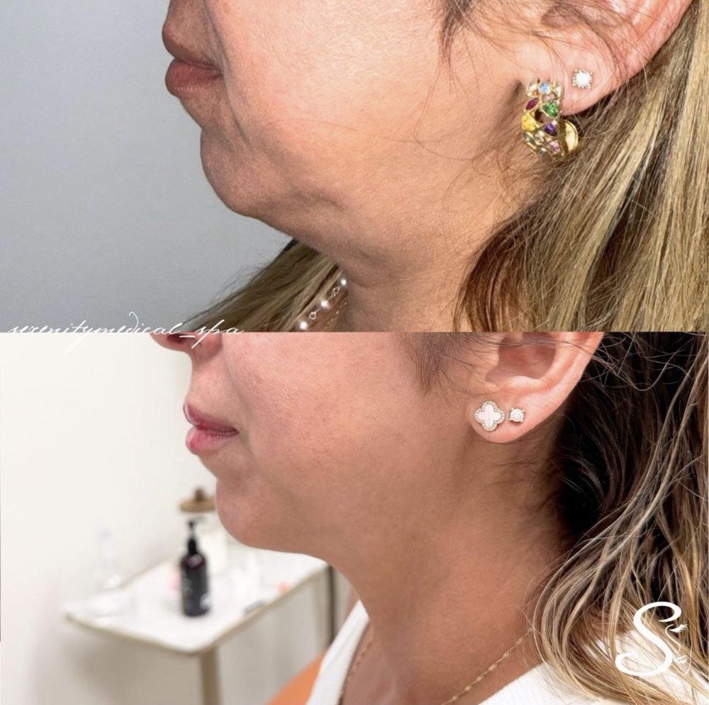 Antes y después Endolift Serenity Medical Spa