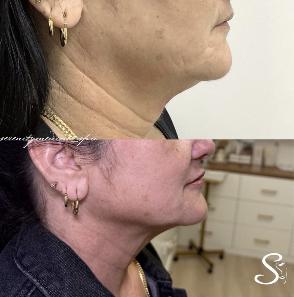 Antes y después Endolift Serenity Medical Spa