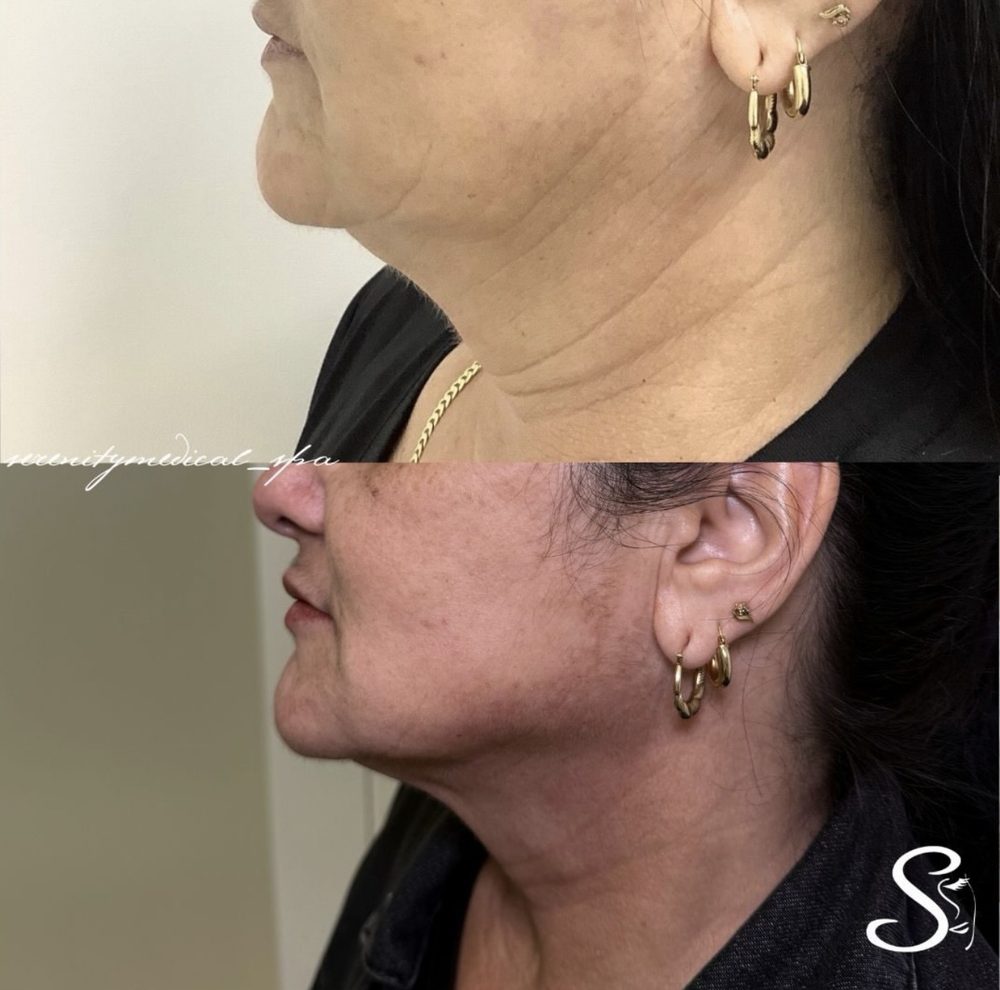 Antes y después Endolift Serenity Medical Spa