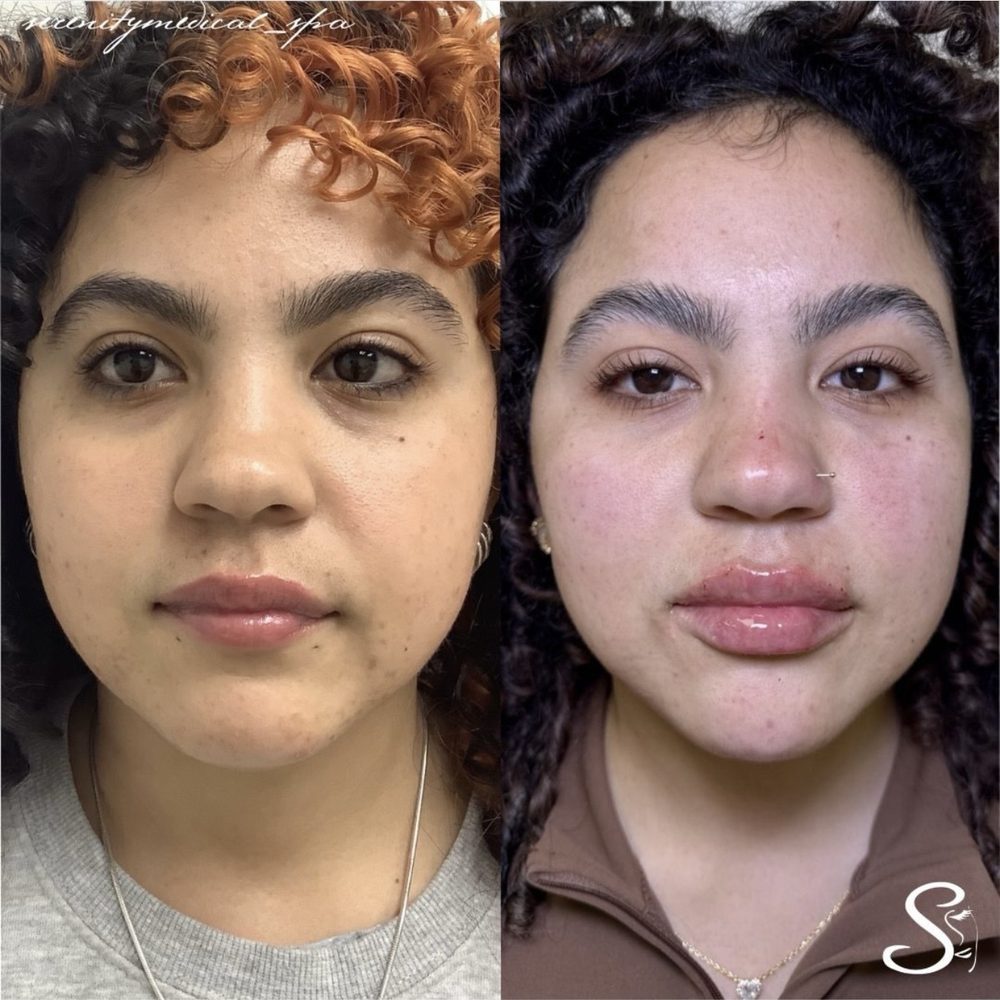 Antes y después Armonización Facial Serenity Medical Spa