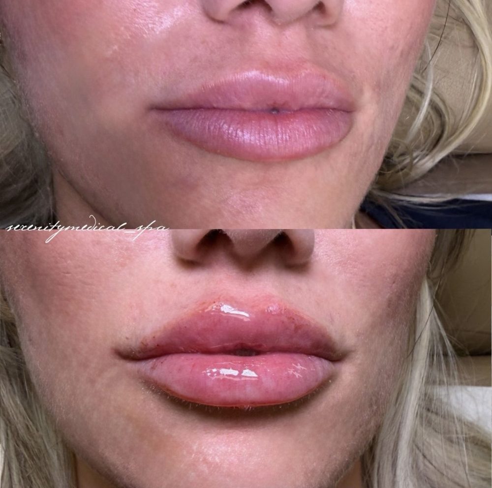 Antes y después Filler Serenity Medical Spa
