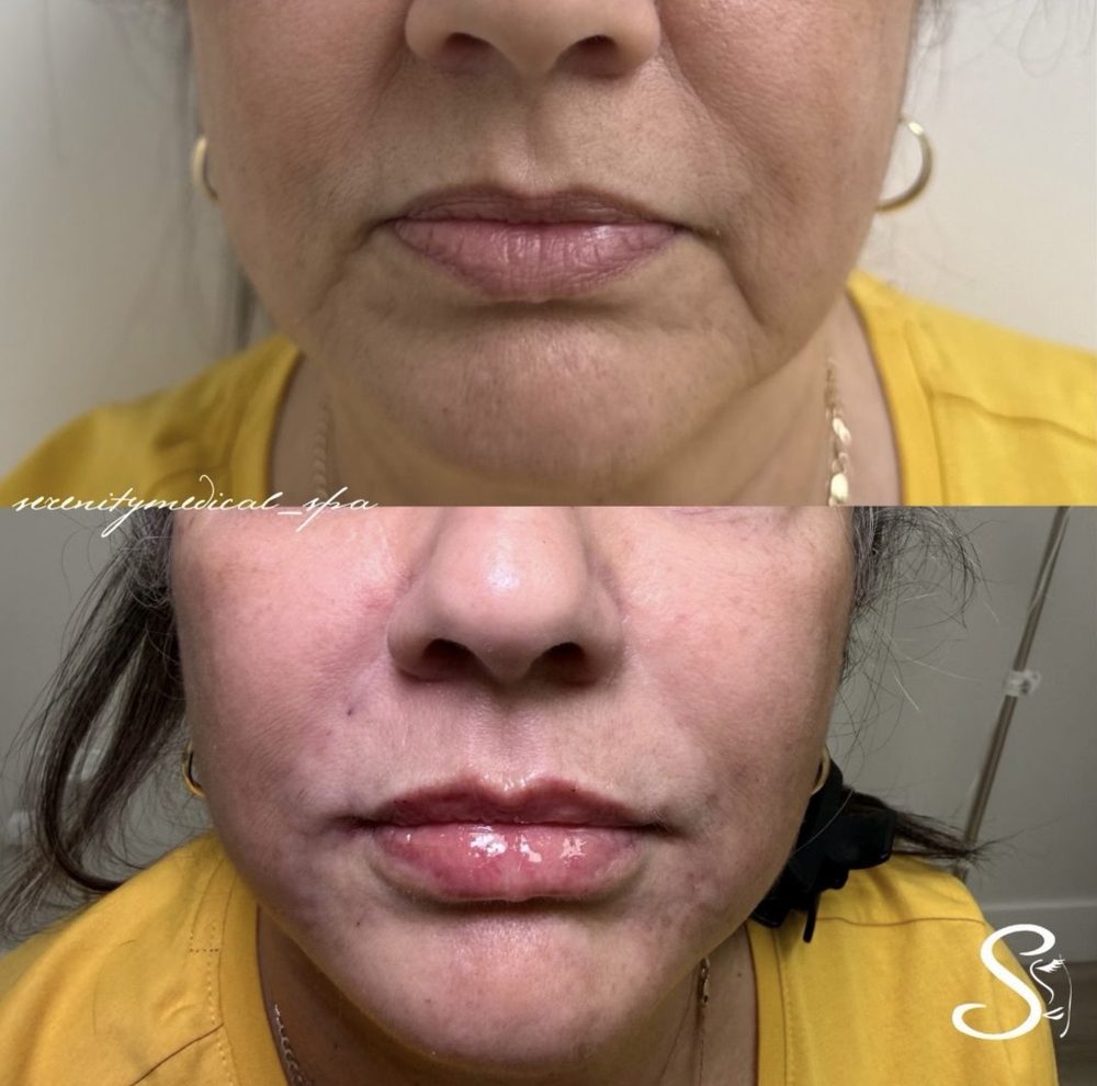 Antes y después Lip Filler Serenity Medical Spa