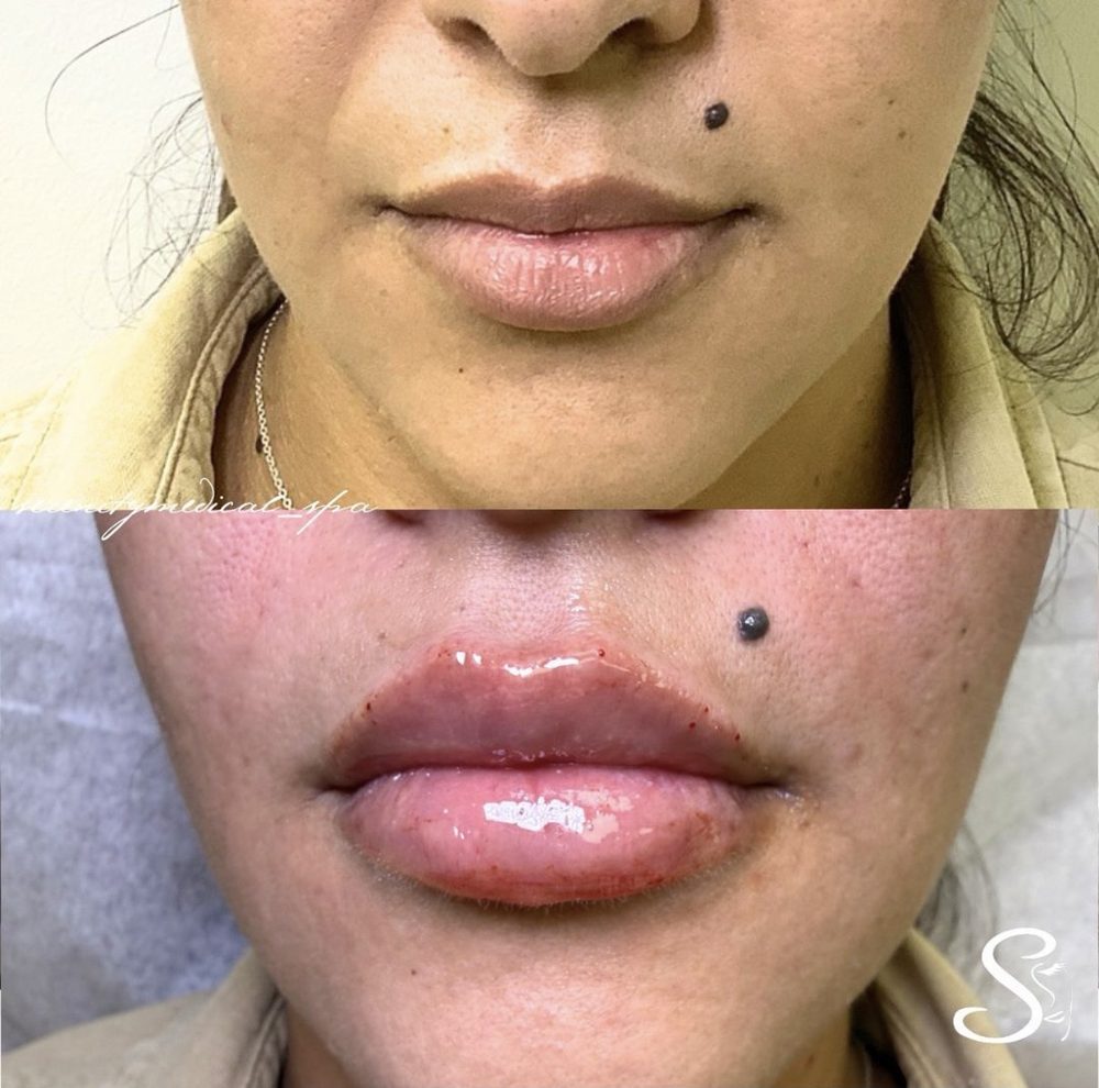 Antes y después Lip Filler Serenity Medical Spa